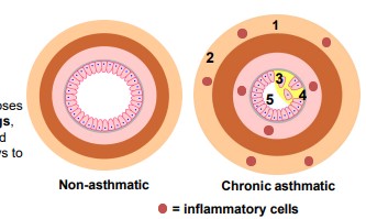 <p><strong>Step 4:</strong> <strong>Epithelial damage exposes sensory nerve endings</strong> → increases airway sensitivity<br><strong>Step 5:</strong> <strong>Airway narrowing by inflammation and bronchoconstriction</strong> →</p><ul><li><p><strong>Increased airway resistance</strong></p></li><li><p><strong>Decreased FEV₁ and Peak Expiratory Flow (PEFR)</strong></p></li><li><p><strong>Bronchial hyperresponsiveness</strong> → airways overreact to triggers</p></li></ul><p></p>