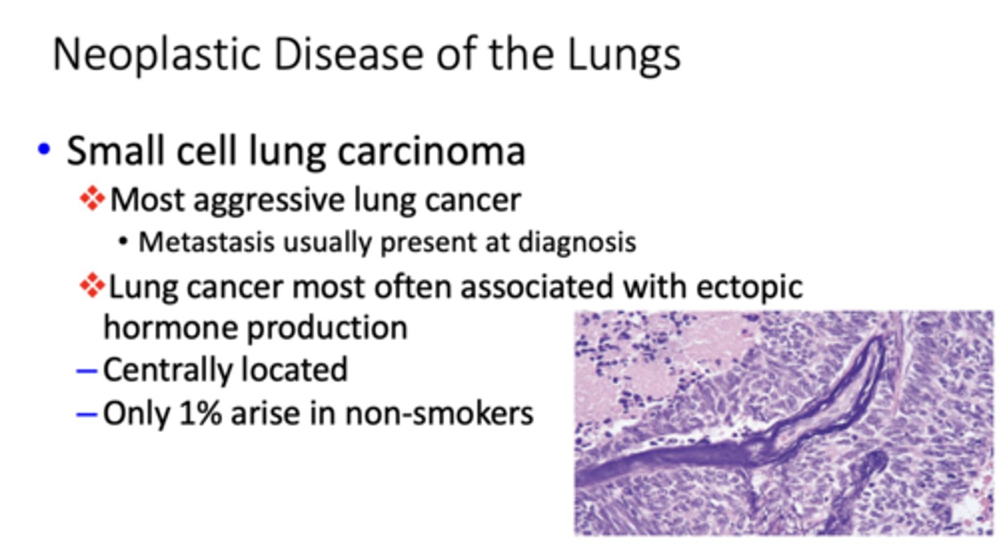 <p>small cell lung carcinoma</p>