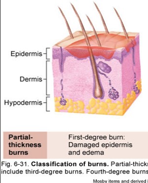 <p>damaged epidermis &amp; edema </p><ul><li><p>partial thickness burns </p></li><li><p>edema ( fluid trapped = swelling)</p></li></ul>