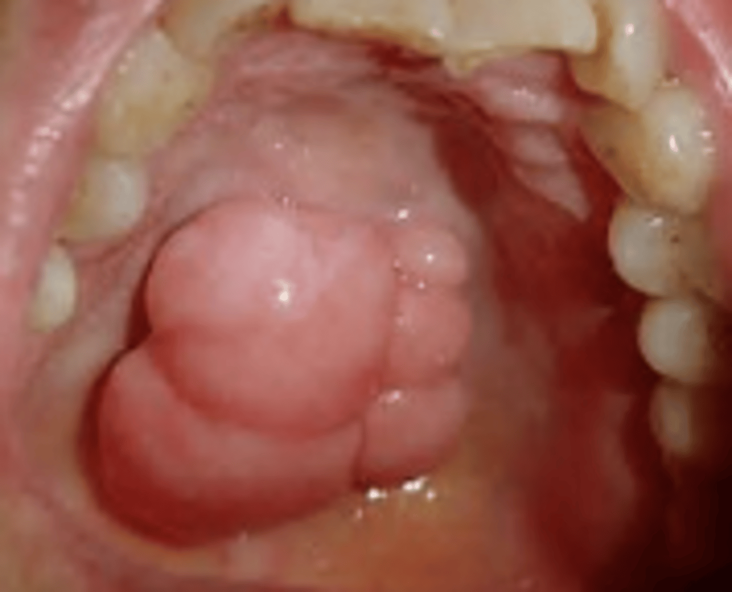 <p>maxillary/palatal tori</p><p>atypical</p>