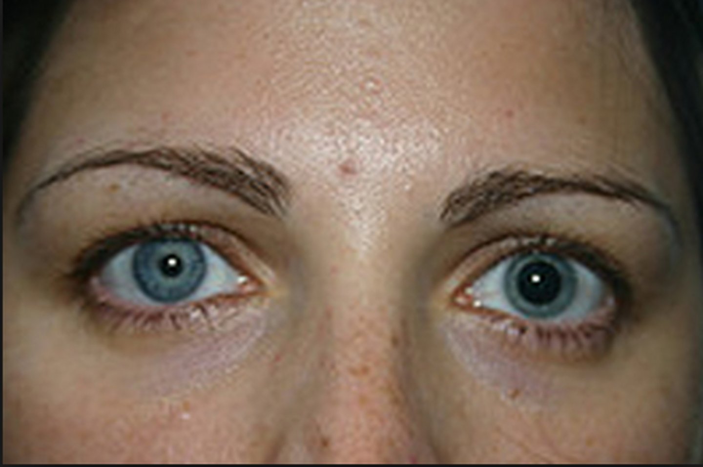 <p>Unequal sized pupils; 80% due to pathology and require further investigation</p>