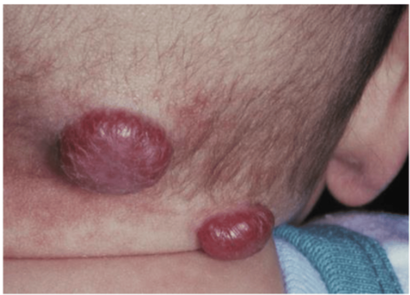 <p>• Congenital lesion</p><p>• Most common tumor of infancy</p><p>• Vascular proliferation</p><p>• Often red/blue</p><p>• Early rapid growth, followed by</p><p>slow involution</p>