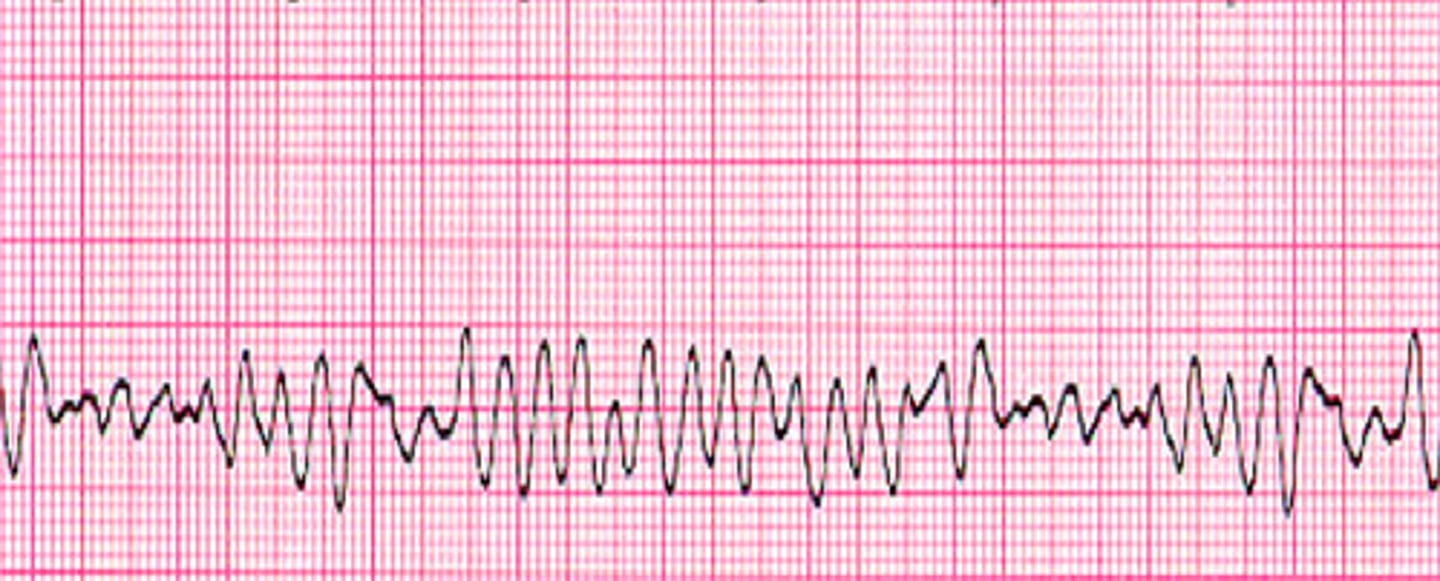 <p>What does the ECG show?</p>