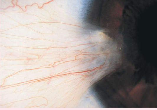 <p><span> a thickening of the bulbar conjunctiva that extends across the nasal side.</span></p>