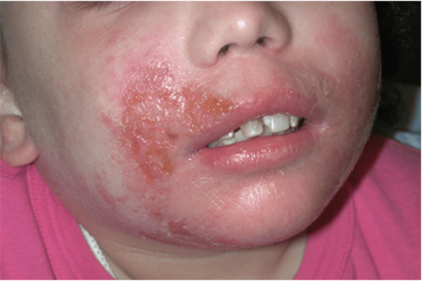 <p>Dried exudate overlying and impaired epidermis</p><p>- Ex: Impetigo</p>