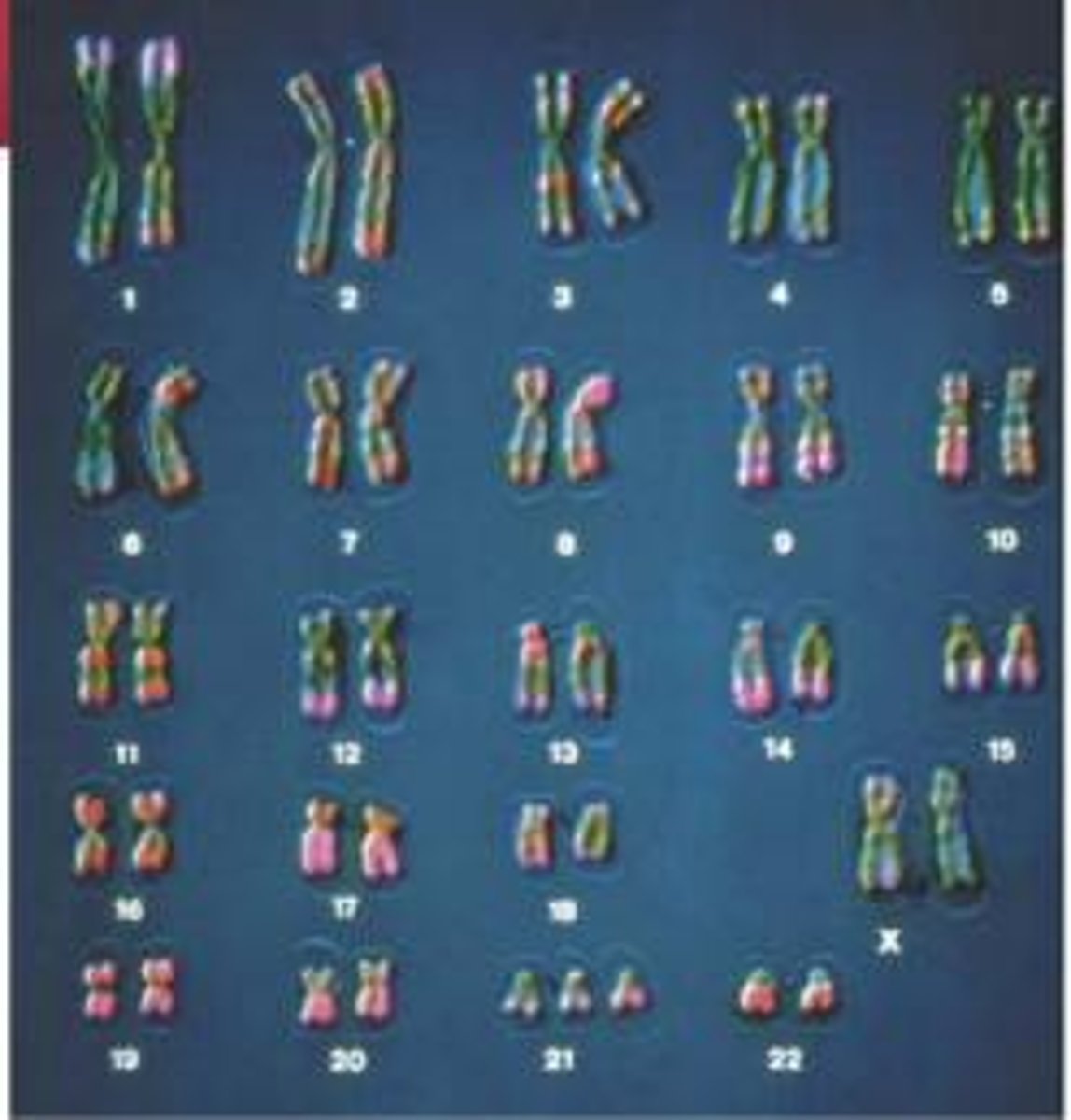 <p>Individual has an extra chromosome 21, 1 out of every 700 children</p>