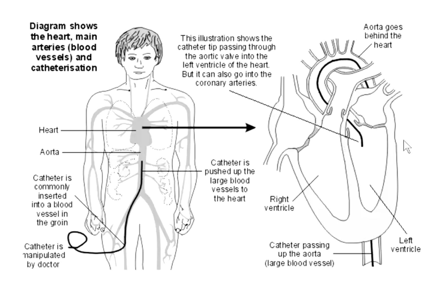 <p>From the femoral artery, a catheter can advance to aorta, coronary arteries and left ventricle</p>