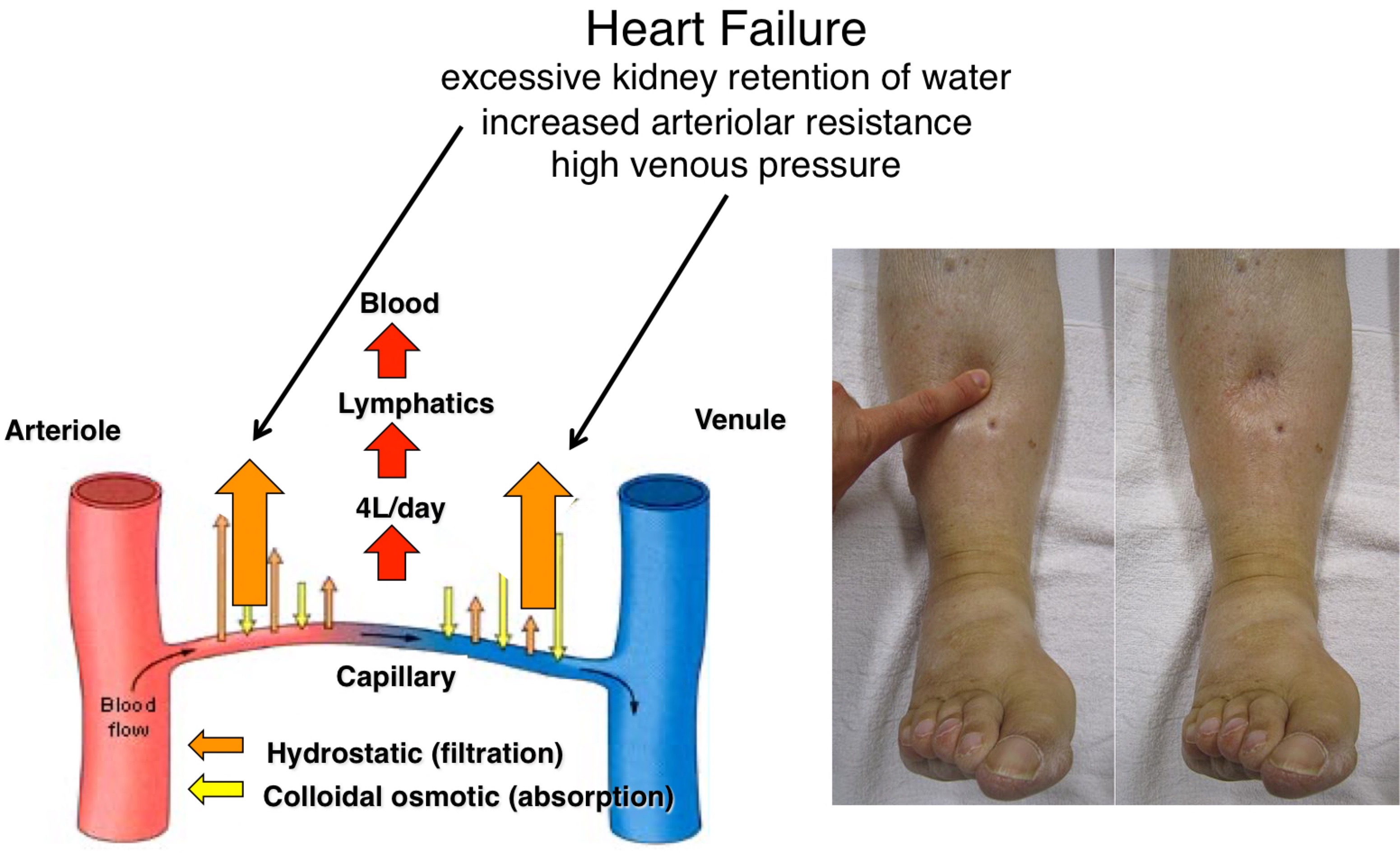 <ul><li><p>Damage heart (heart failure)</p></li><li><p>heart doesn’t function properly lead to heart failure</p></li><li><p>Heart will try and retain more water to increase pressure, net migration of more water outside of arterial end</p></li></ul>