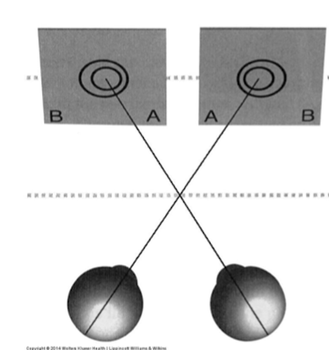 <p>this is crossed disparity = pt is diverging</p><p>the right eye is looking at the right target</p><p>the left eye is looking at the left target</p><p>if you split the right target in the middle the right eye see's the inner circle mostly to the left side</p><p>and thus this is crossed disparity and we know crossed disparity makes things seem closer thus why pt sees the inner circle floating towards them.</p><p>you have to instruct pt to try and cross their eyes more to see the inner circle floating away from them aka converging (uncrossed dispairty)</p>