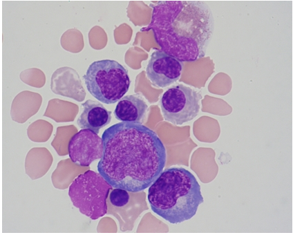 <p>Identify the predominant nucleated cell in this cerebrospinal fluid cytospin differential.</p><p>Nucleated RBCs</p><p>Neutrophils</p><p>Metamyelocte</p><p>Tumor cells </p>