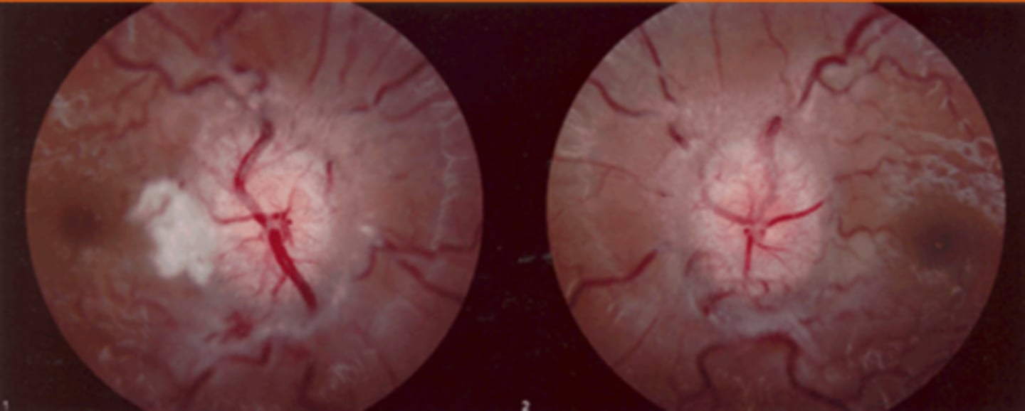 <p>idiopathic scarring of ONH</p>