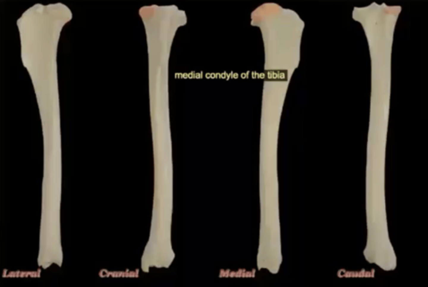 <p>medial, larger condyle of the top of the tibia</p>
