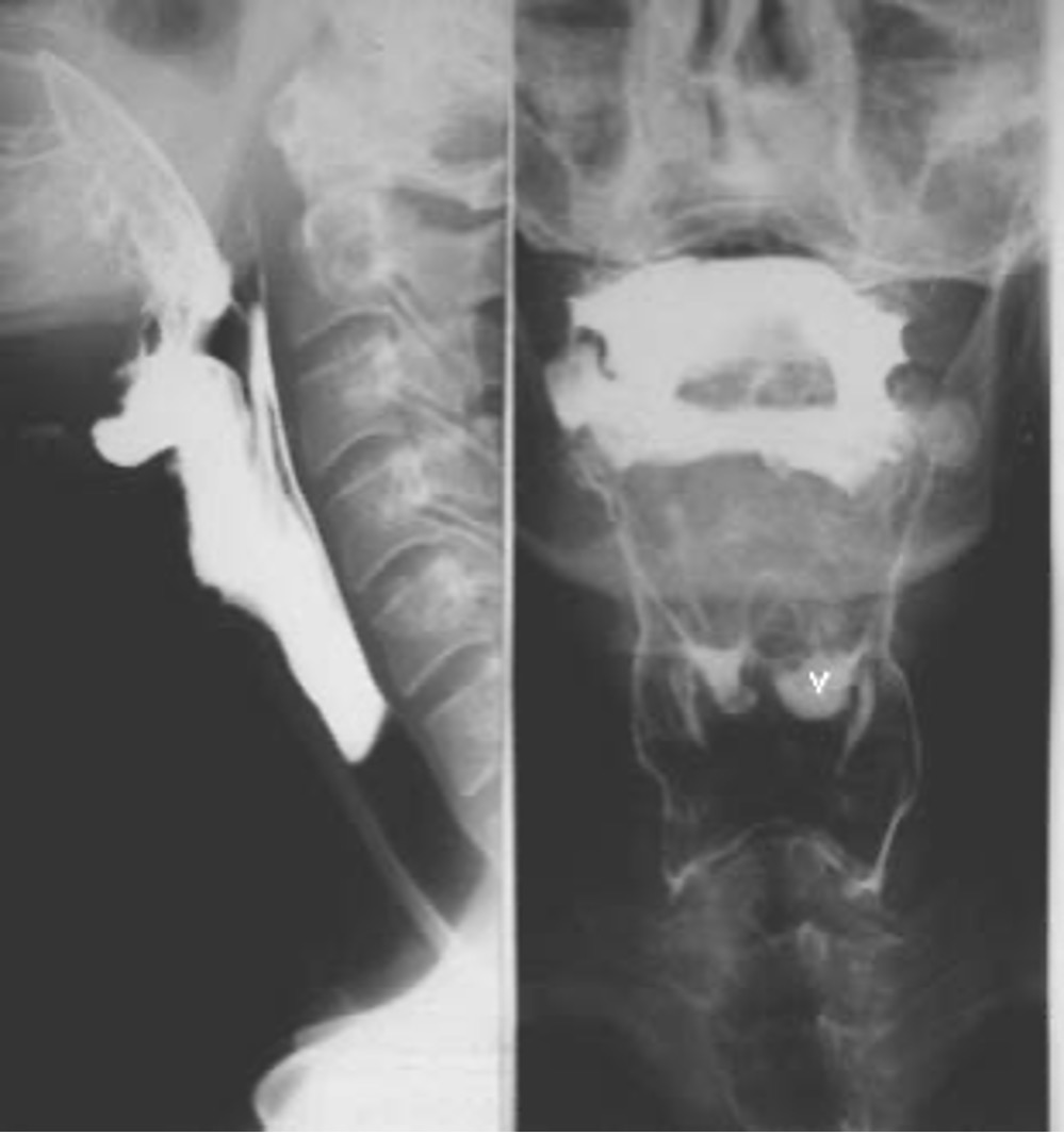 <p><span>Speech therapists can analyse the various stages of swallow (bonus point for: Oral preparatory, Oral propulsive, Pharyngeal, Oesophageal) and prescribe treatment such as swallowing/coughing exercises (to improve muscle tone) or special diets to prevent aspiration. </span></p>