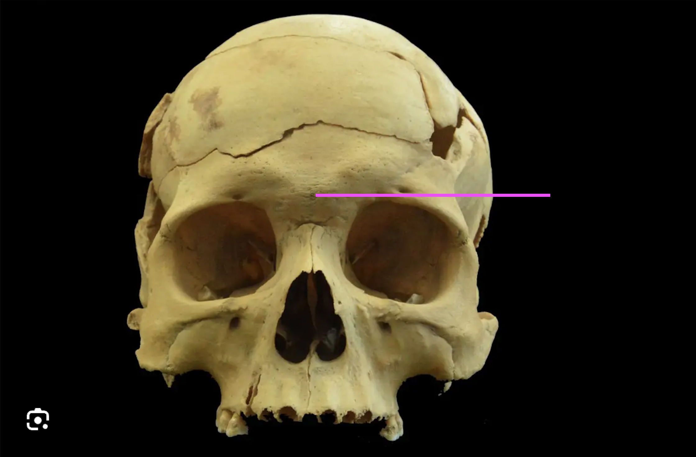 <p>What bone marking is this?</p>