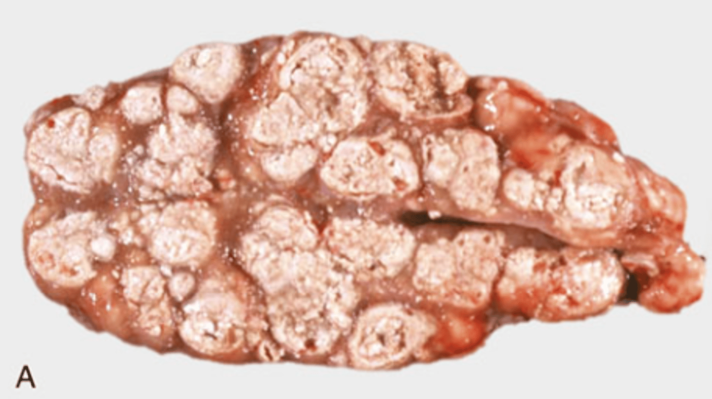 <p>What type of necrosis is being shown in this image?</p>