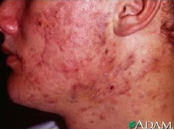 <p>Condition in males with an extra Y chromosome</p><ul><li><p>has more masculine features</p></li><li><p>More testosterone</p></li><li><p>Taller, excess acne, more lean / tougher to put on muscle</p></li><li><p>Not much issue with reproduction</p></li></ul><p></p>
