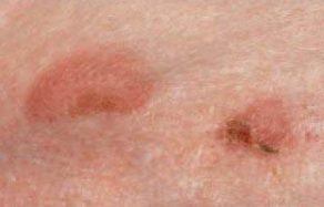<p>Collarete que se desprende periféricamente de una mácula.</p><p>Enfermedad bacteriana de la piel, común en perros y gatos, asociada a Staphylococcus intermedius. Prúrito y foliculitis, lesiones en vientre y tronco.</p>