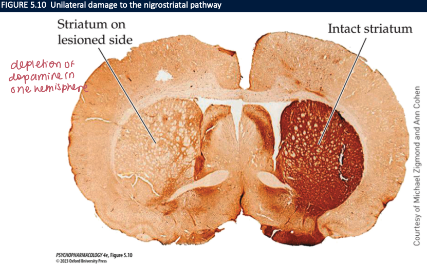<ol><li><p>Parkinson’s disease</p></li><li><p>mutations in henes for TH, AADC, TH cofactor</p></li><li><p>experimental lesions of the nigrostriatal tract by neurotoxins that damage/destroy midbrain DA neurons + lesion their pathways </p></li><li><p>mice genetically engineered to lack DA → DD mice</p></li></ol><p></p>