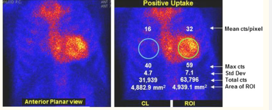 <p>does this image show negative or positive uptake</p>