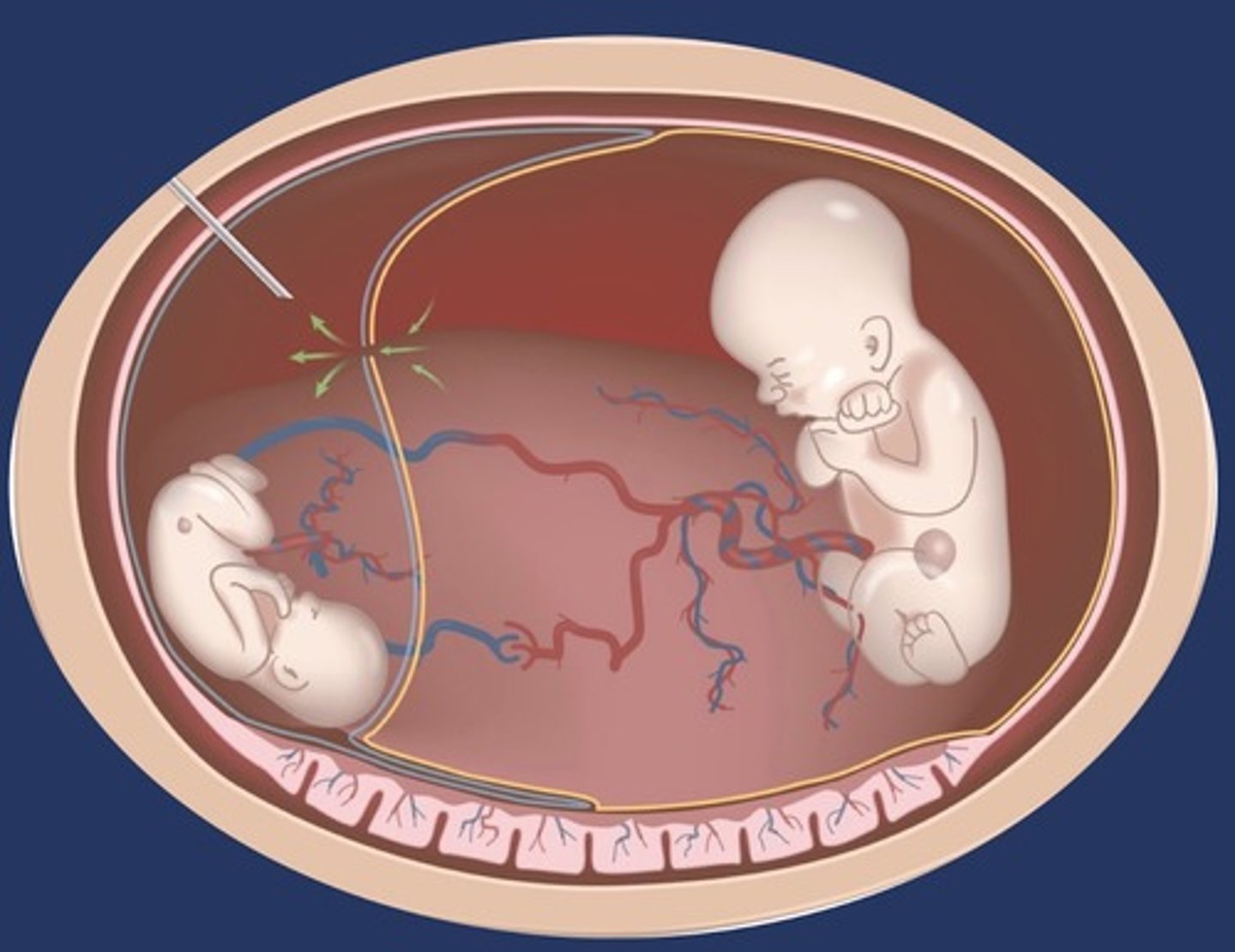 <p>Hole created between twins to equalize pressures</p><p>80% survival of 1 twin</p><p>60% survival for both twins</p>