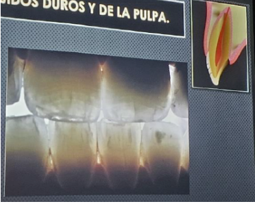 <p><span>corresponde a una fisura del esmalte no existiendo por tanto pérdida de sustancia dentaria</span></p>