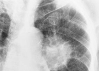 <p>benign or malignant </p>