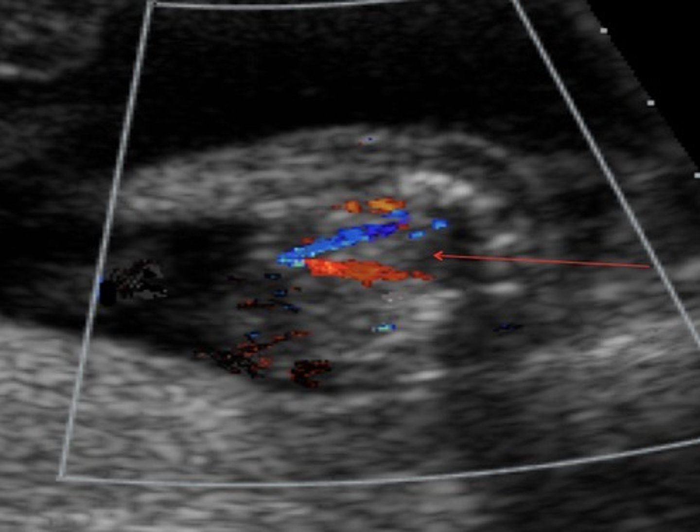<p>Amniotic fluid discrepancy</p><p>Absent bladder in donor twin</p>