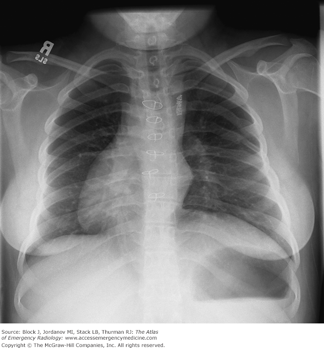 <p>Dextroposition</p>