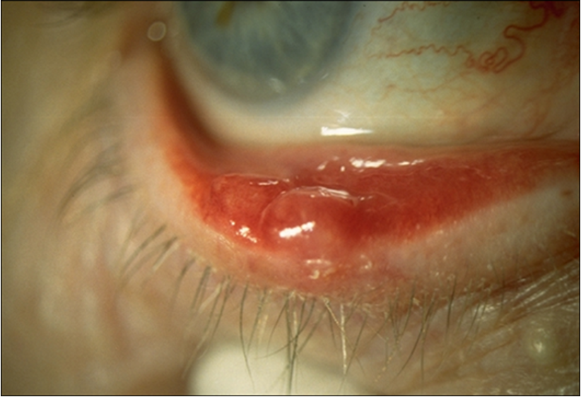 <ul><li><p>well-defined ,<strong> 2-8mm subcutaneous nodule in tarsal plate</strong></p></li></ul><p></p><ul><li><p>may be associated with <strong>blepharitis and astigmatism</strong></p></li></ul><p></p>