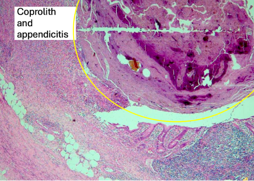 <p><span>Inflammation started due to large coprolith → ischemia, epithelium disclamation and inflammation in deep layers of appendix</span></p>