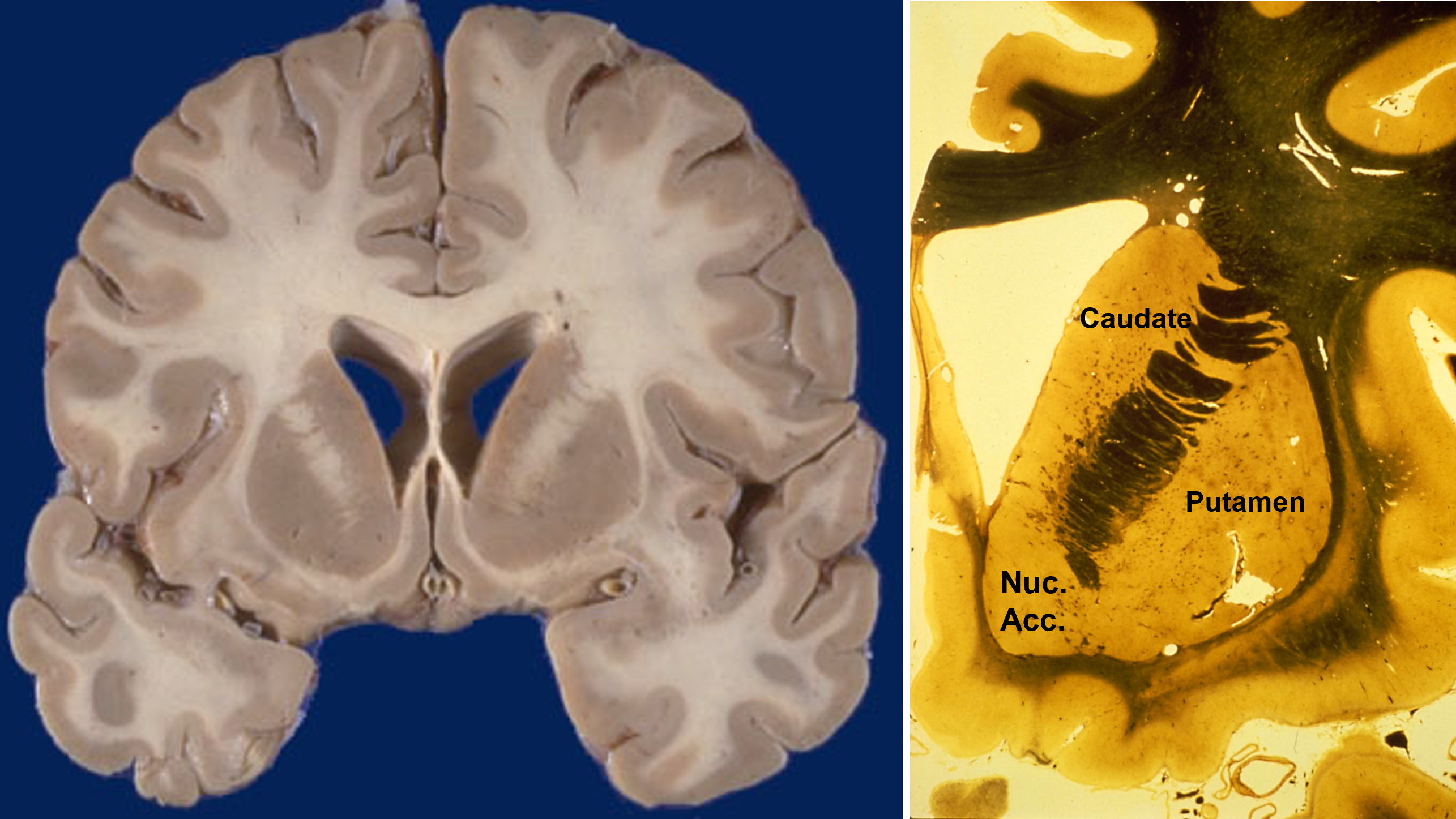 <p>the basal ganglia have three input nuclei that receive projections from all parts of cerebral cortex</p>
