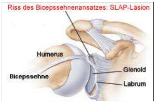 <p>Riss lange Bizepssehne - SLAP-Läsion</p>