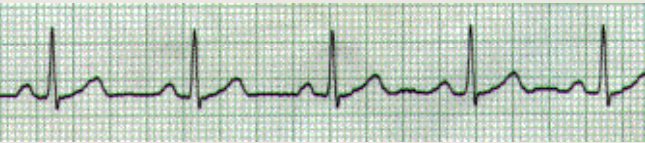 <p>Ritmul sinusal normal</p>