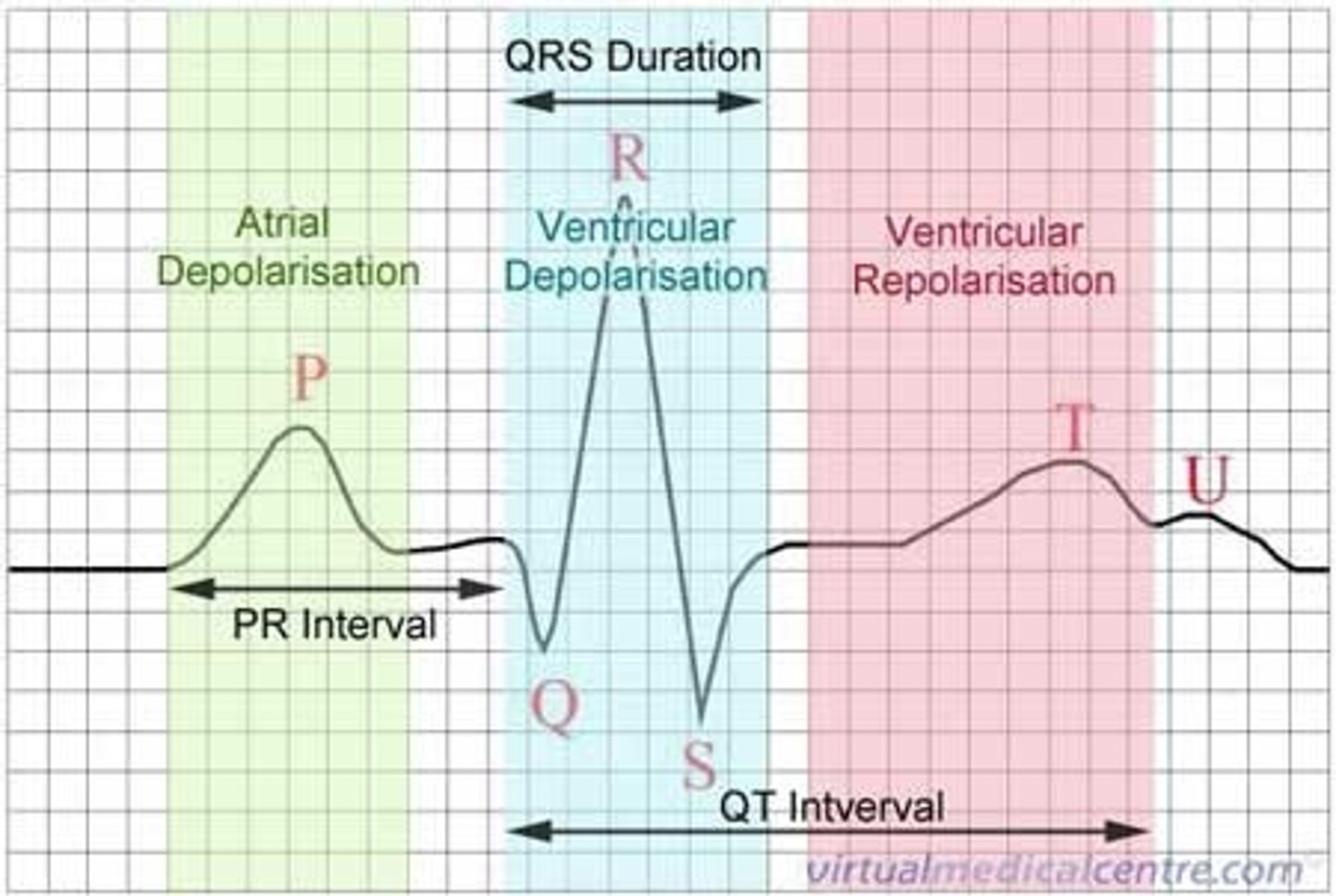 <p>• P Wave: Atrial depolarization</p><p>• QRS Wave: Ventricular depolarization (hides atrial repolarization)</p><p>• T Wave: Ventricular repolarization</p>