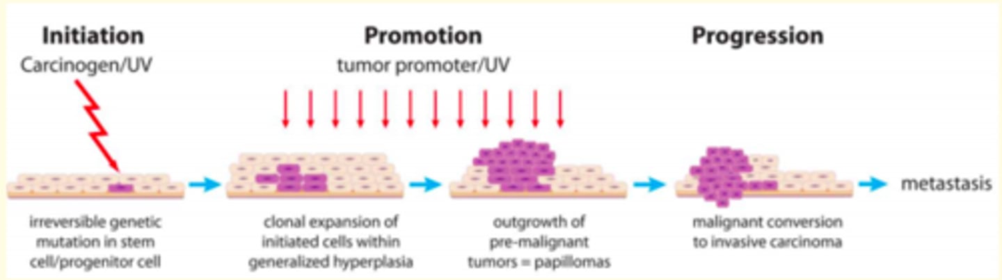 <p>1) Initiation </p><p>Irreversible genetic mutation occurs in stem cell/progenitor cell</p><p>2) Promotion </p><p>Clonal expansion of initiated cells within generalised hyperplasia </p><p>Outgrowth of pre-malignant tumours = papillomas </p><p>3) Progression </p><p>Malignant conversion to an invasive carcinoma </p>