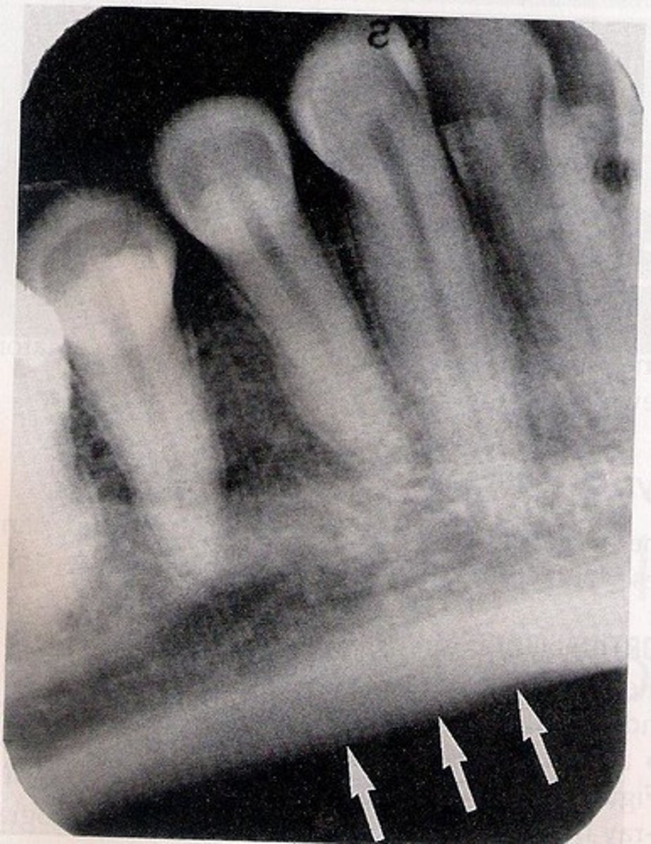 <p>Radiopaque; immediately surrounds and supports teeth.</p>