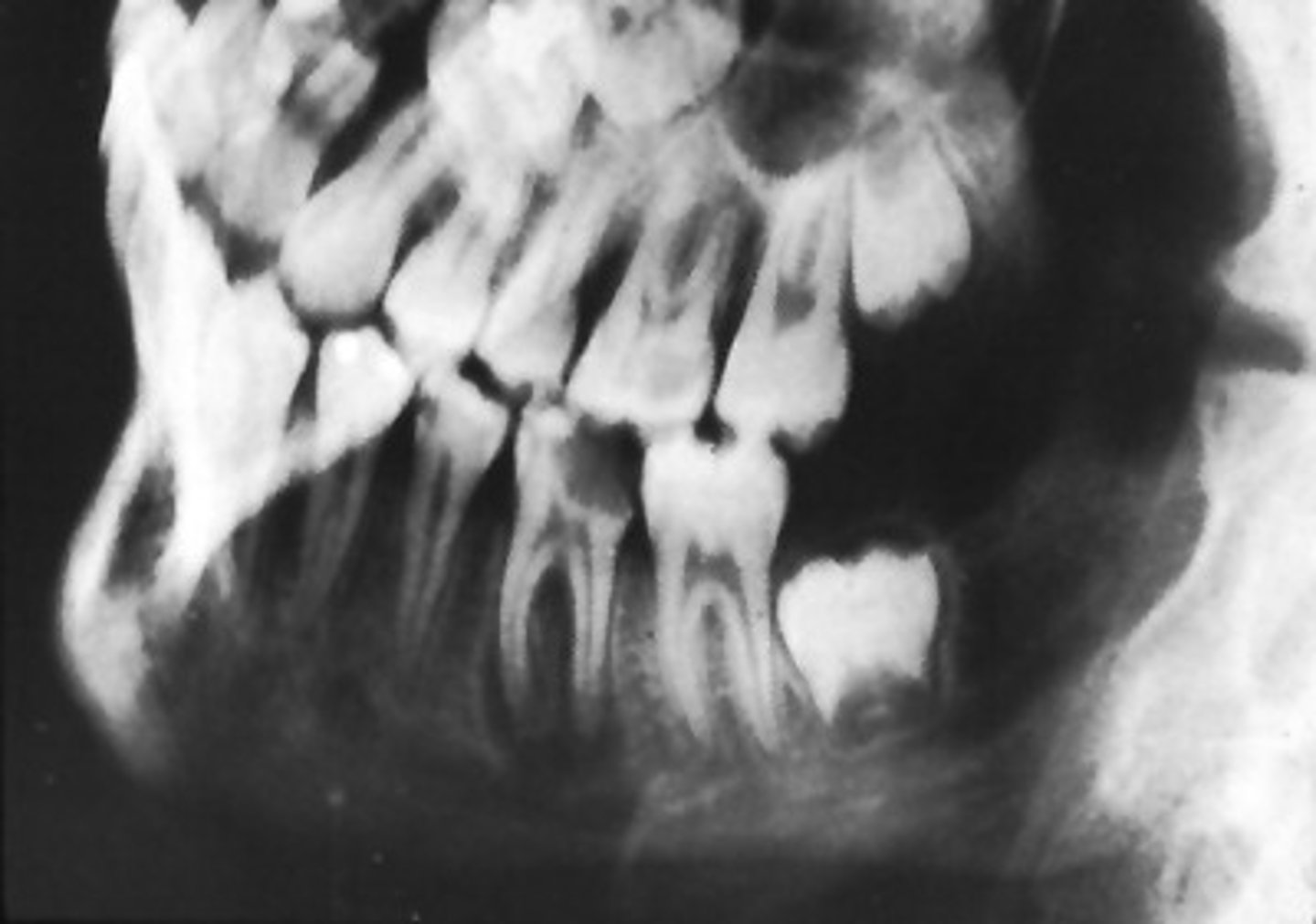 <p>Necrotic bony islands</p>