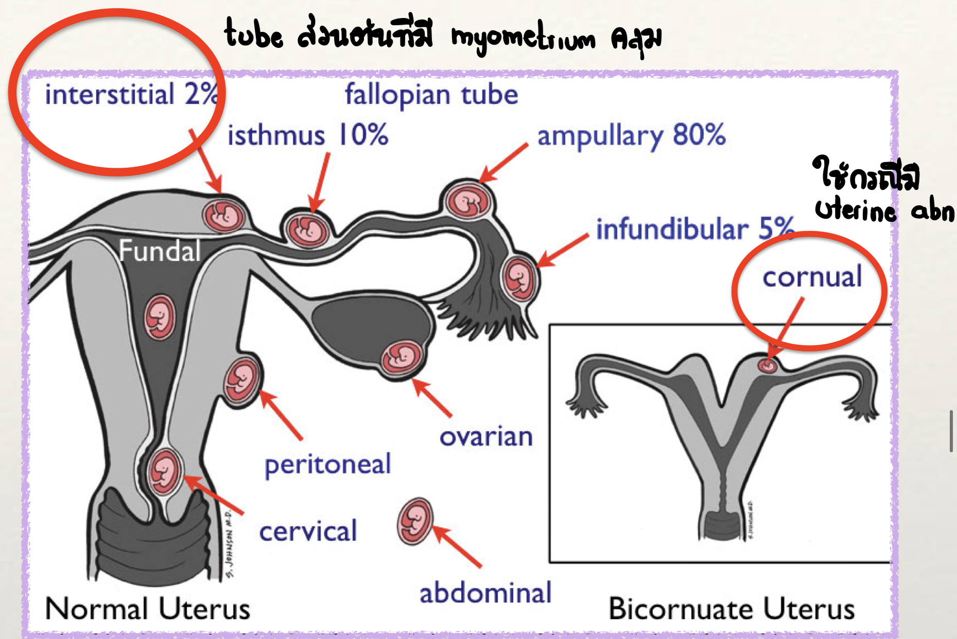 <p>Rudimentary horn of a uterus with a Müllerian anomaly</p>