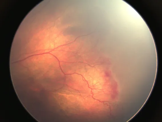 <p>eye disease that occurs when abnormal blood vessels grow in the retina of premature babies.</p>