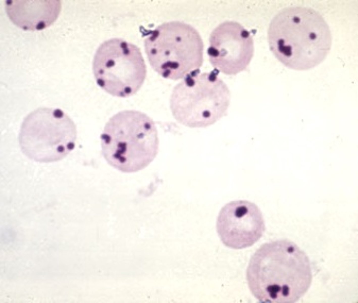 <p>G6PD deficiency</p><p>Alpha-thalassaemia</p>