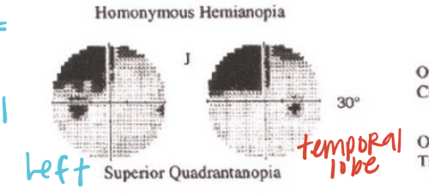 <p>What would be the VF defect if Meyer's loop through the Right temporal lobe was cut?</p>