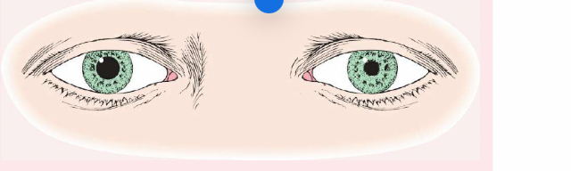<p>anisocoria</p>
