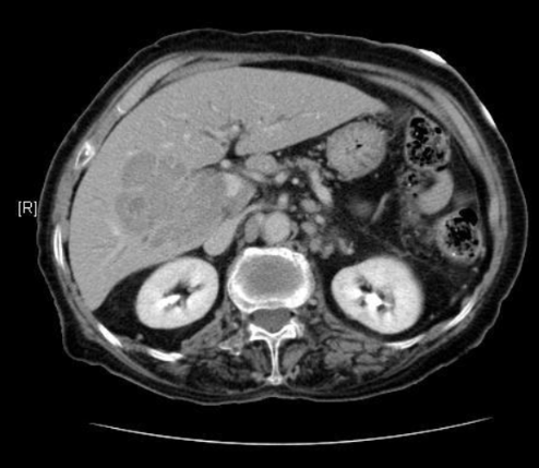 <p><span style="color: #02e321">CT Liver</span> evaluates liver for</p>