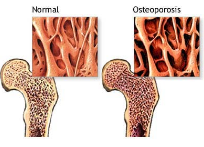Osteoporosis
