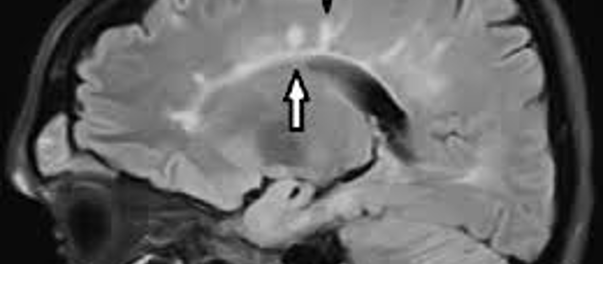 <ul><li><p>MRI &gt; CT → plaques / Dawson’s fingers</p></li></ul><ul><li><p>evoked potential test → time for nerves to respond to full stimuli (VER or VEP MC)</p></li><li><p>CSF → <strong>oligoclonal bands</strong>, myelin basic protein inc, etc</p></li><li><p>McDonald criteria</p></li></ul><p></p>