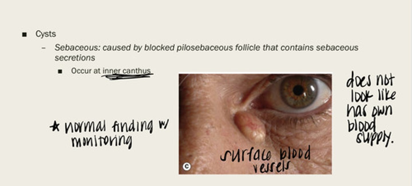 <p>What are sebaceous cysts caused by?</p>