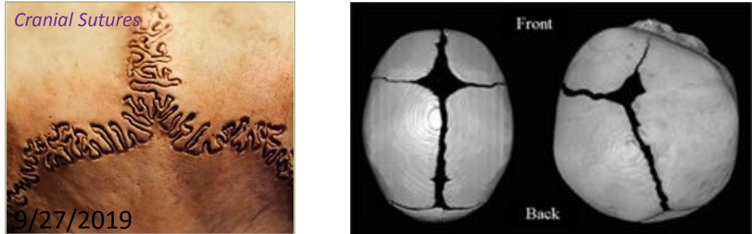 <p>Cranial sutures are thin layers of dense fibrous connective tissue found between the bones of the skull. In adults, they appear as seams connecting the skull bones, while in newborns, they consist of linear attachments of fibrous tissue and fontanelles, allowing for skull flexibility during birth and growth.</p><p></p>