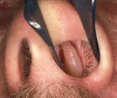 <p>is what lines the nasal cavity. Changes in the nasal mucosa indicate bacterial infections, allergies, viral infections…</p>