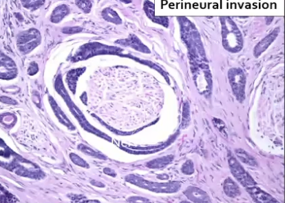 <p>What are some histological features of Adenoid cystic carcinoma?</p>