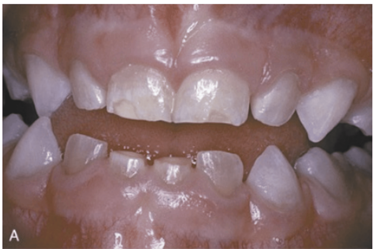 <p>What do dentinal defects in Osteogenesis Imperfecta lead to?</p>